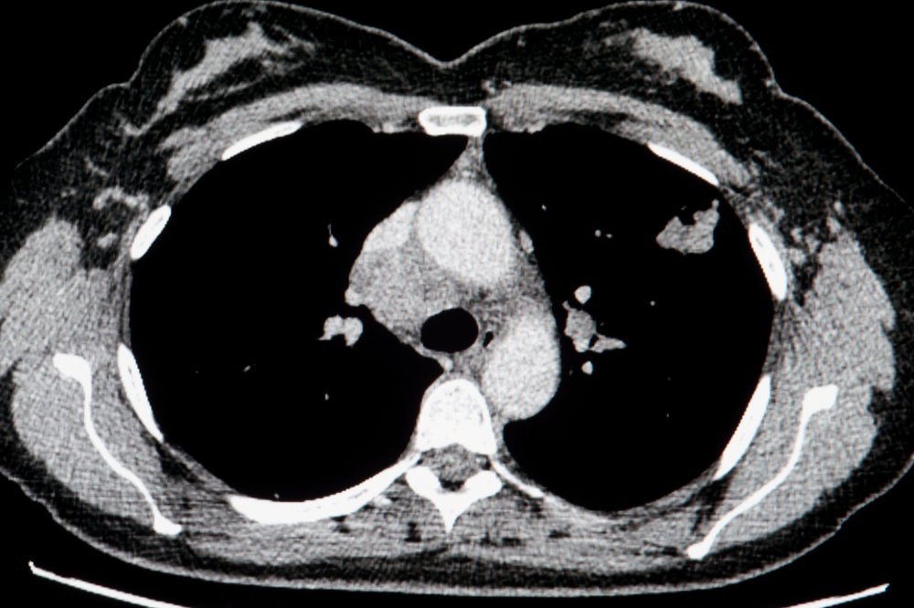 컴퓨터 단층촬영 (CT : Computerized Tomography) 첨부 이미지