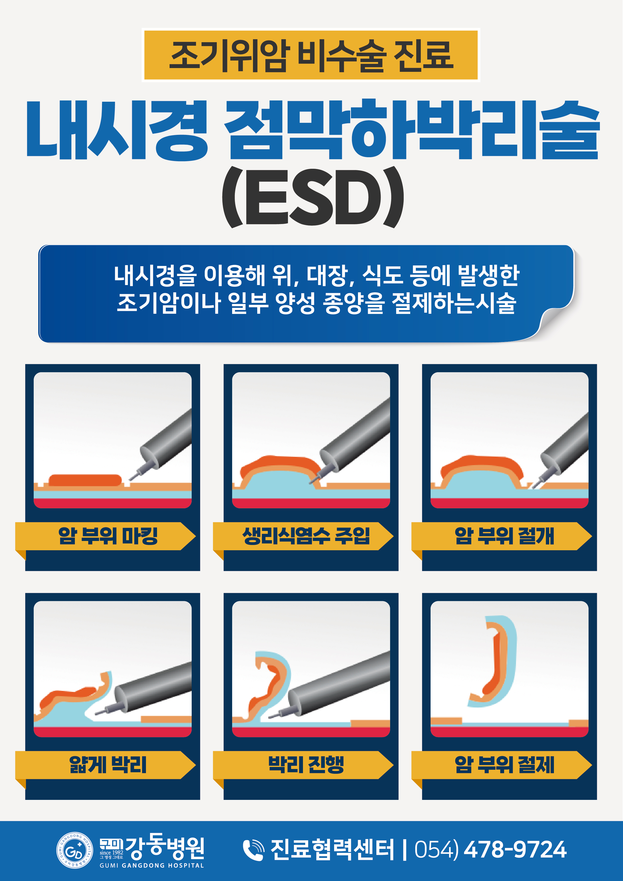 조기위암 비수술 진료 | 내시경점막하박리술(ESD)내시경 첨부 이미지